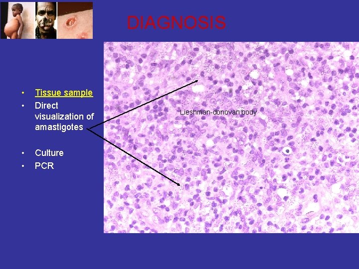 DIAGNOSIS • • Tissue sample Direct visualization of amastigotes • • Culture PCR Lieshman-donovan