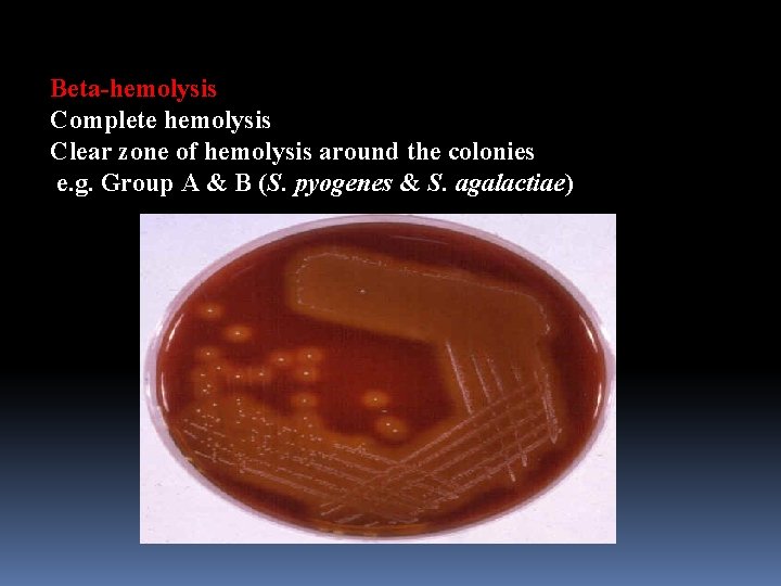 Beta-hemolysis Complete hemolysis Clear zone of hemolysis around the colonies e. g. Group A