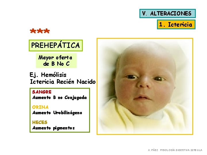 V. ALTERACIONES *** 1. Ictericia PREHEPÁTICA Mayor oferta de B No C Ej. Hemólisis