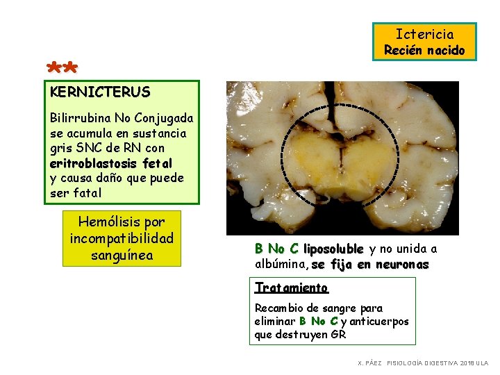 Ictericia Recién nacido ** KERNICTERUS Bilirrubina No Conjugada se acumula en sustancia gris SNC