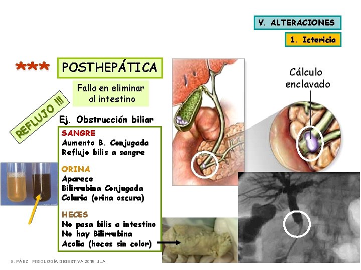 V. ALTERACIONES 1. Ictericia *** POSTHEPÁTICA !!! Falla en eliminar al intestino O J