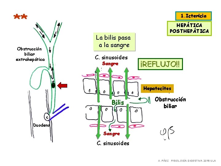 ** 1. Ictericia Obstrucción biliar extrahepática La bilis pasa a la sangre C. sinusoides