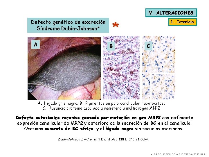 V. ALTERACIONES Defecto genético de excreción Síndrome Dubin-Johnson* A * B 1. Ictericia C