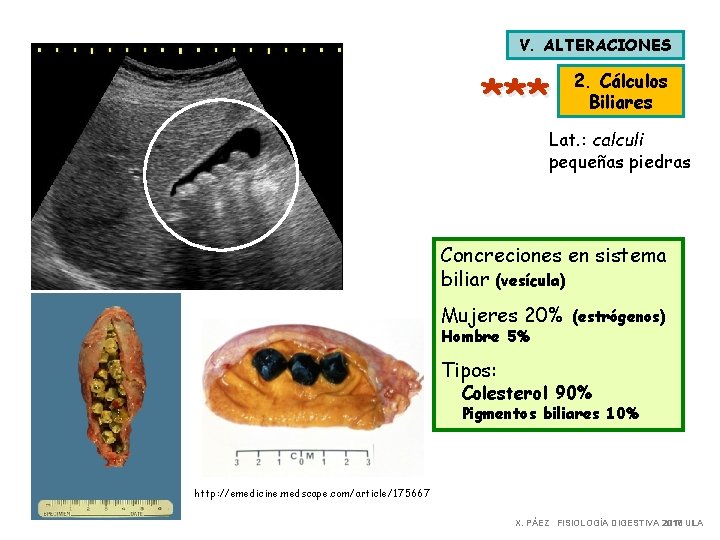 V. ALTERACIONES *** 2. Cálculos Biliares Lat. : calculi pequeñas piedras Concreciones en sistema