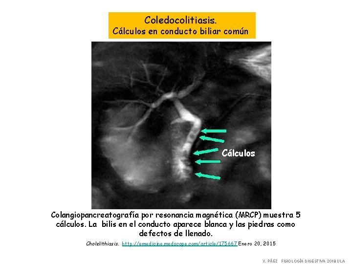 Coledocolitiasis. Cálculos en conducto biliar común Cálculos Colangiopancreatografía por resonancia magnética (MRCP) muestra 5