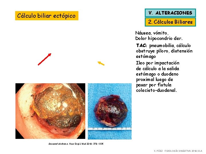 Cálculo biliar ectópico V. ALTERACIONES 2. Cálculos Biliares Náusea, vómito, Dolor hipocondrio der. TAC: