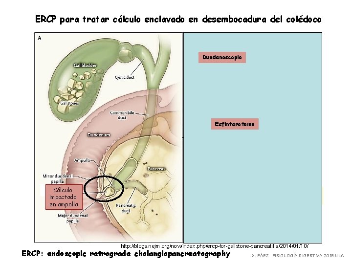 ERCP para tratar cálculo enclavado en desembocadura del colédoco Duodenoscopio Esfinterotomo Cálculo impactado en