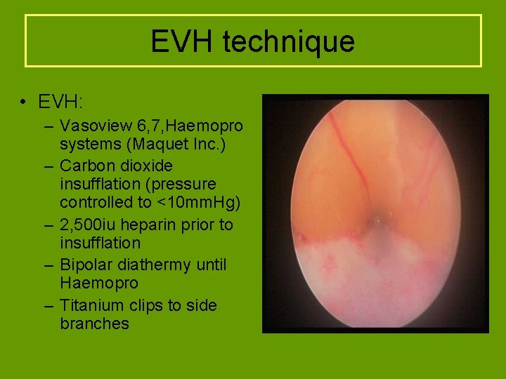 EVH technique • EVH: – Vasoview 6, 7, Haemopro systems (Maquet Inc. ) –