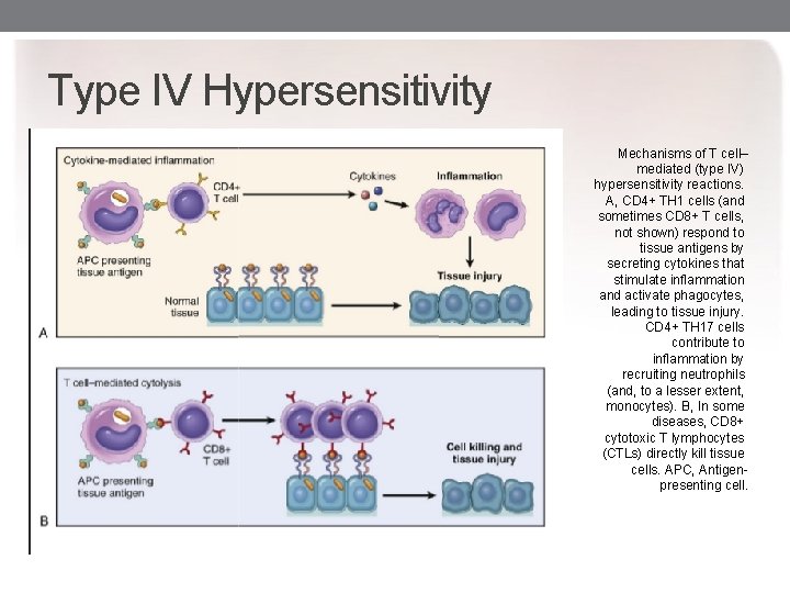 Type IV Hypersensitivity Mechanisms of T cell– mediated (type IV) hypersensitivity reactions. A, CD