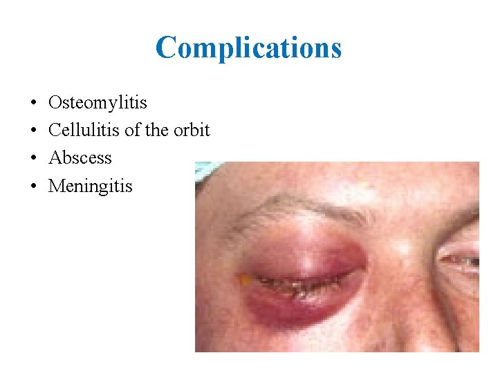 Complications • • Osteomylitis Cellulitis of the orbit Abscess Meningitis 