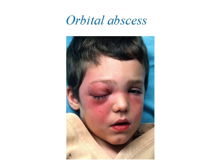 Orbital abscess 