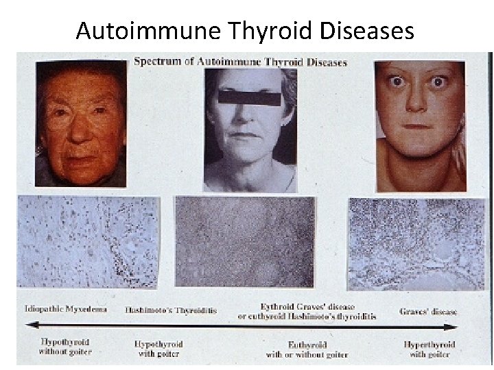 Autoimmune Thyroid Diseases 