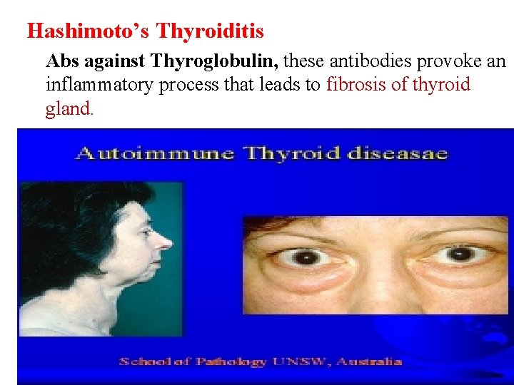 Hashimoto’s Thyroiditis Abs against Thyroglobulin, these antibodies provoke an inflammatory process that leads to