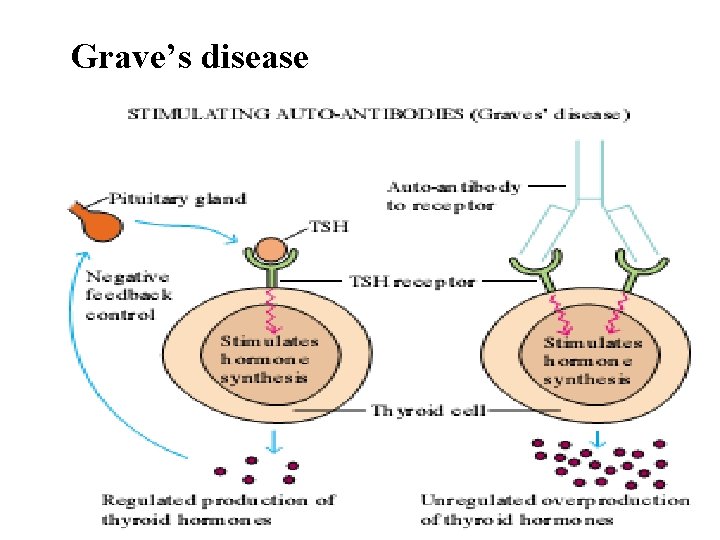 Grave’s disease 