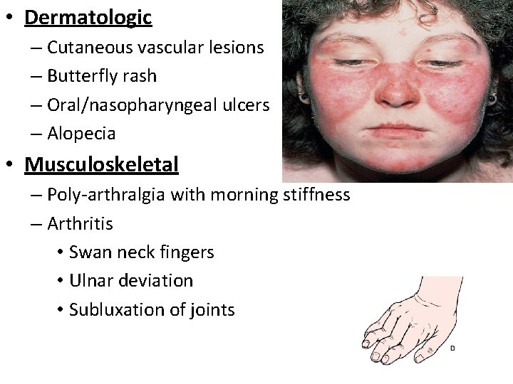  • Dermatologic – Cutaneous vascular lesions – Butterfly rash – Oral/nasopharyngeal ulcers –