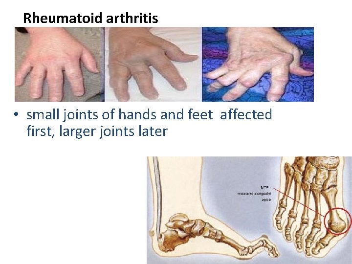 Rheumatoid arthritis • small joints of hands and feet affected first, larger joints later