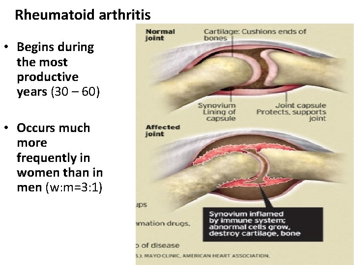 Rheumatoid arthritis • Begins during the most productive years (30 – 60) • Occurs