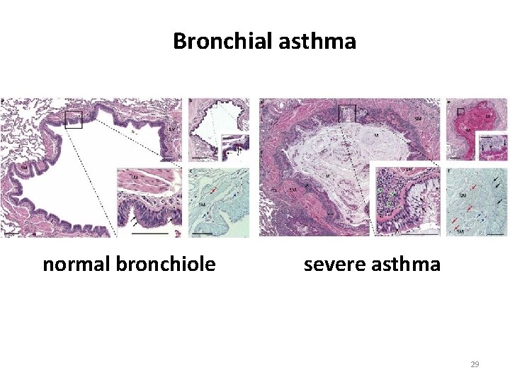 Bronchial asthma normal bronchiole severe asthma 29 