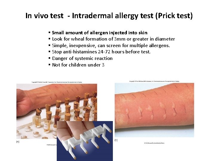 In vivo test - Intradermal allergy test (Prick test) § Small amount of allergen