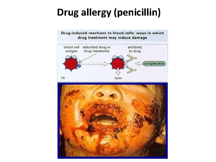 Drug allergy (penicillin) 