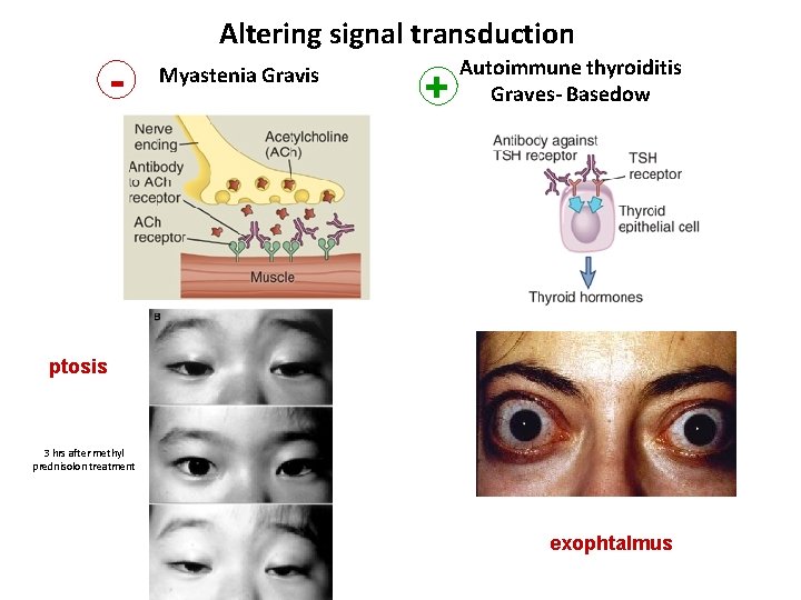 Altering signal transduction - Myastenia Gravis + Autoimmune thyroiditis Graves- Basedow ptosis 3 hrs
