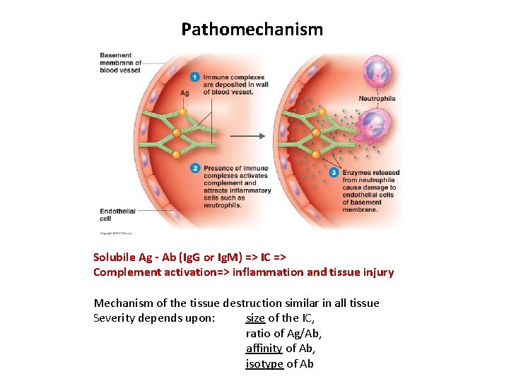 Pathomechanism Solubile Ag - Ab (Ig. G or Ig. M) => IC => Complement