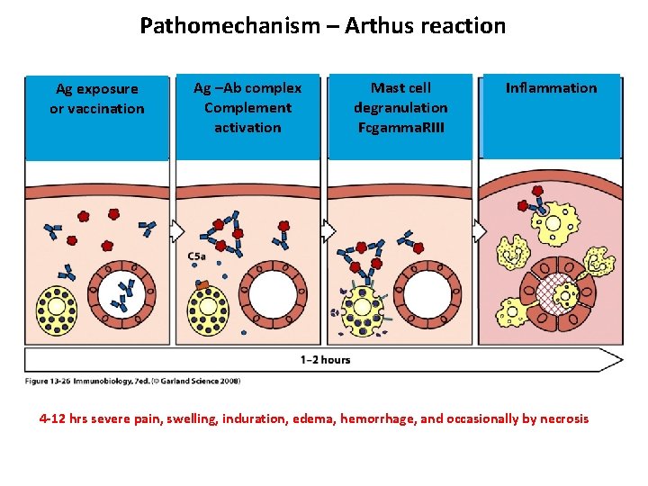 Pathomechanism – Arthus reaction Ag exposure or vaccination Ag –Ab complex Complement activation Mast