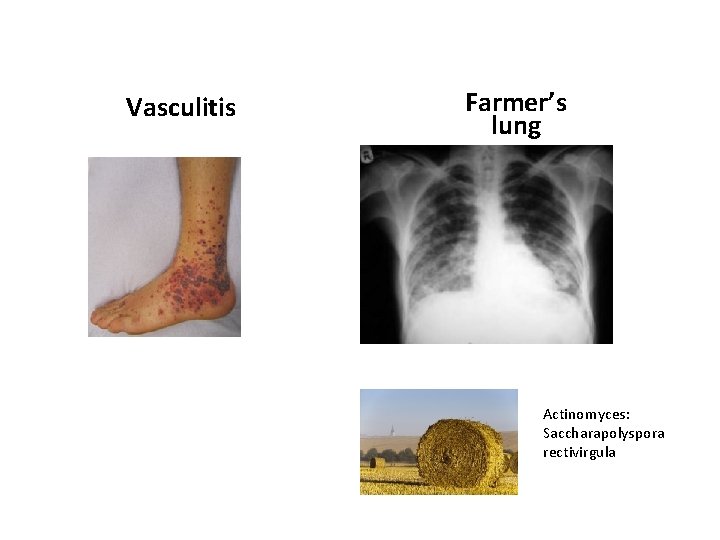 Vasculitis Farmer’s lung Actinomyces: Saccharapolyspora rectivirgula 