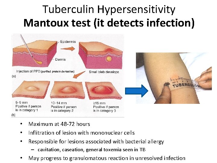 Tuberculin Hypersensitivity Mantoux test (it detects infection) (purified protein derivative) • Maximum at 48