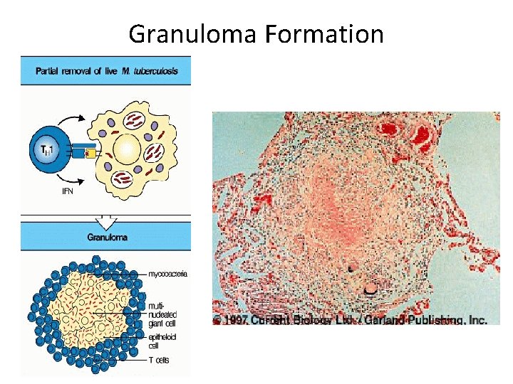 Granuloma Formation 