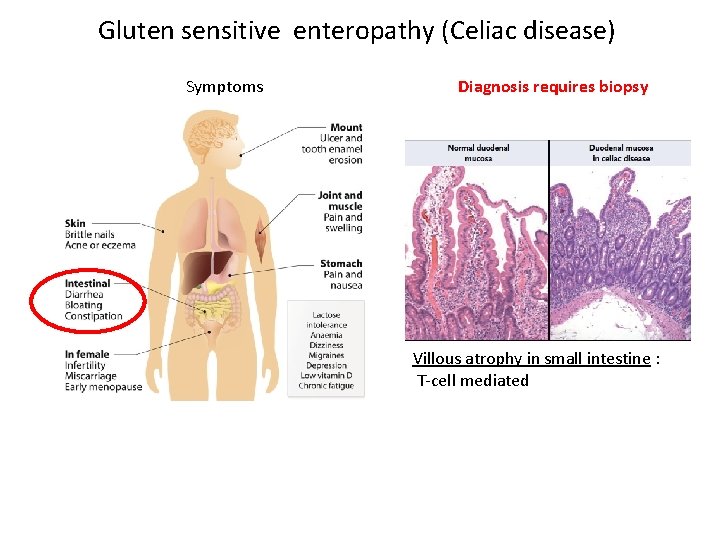 Gluten sensitive enteropathy (Celiac disease) Symptoms Diagnosis requires biopsy Villous atrophy in small intestine