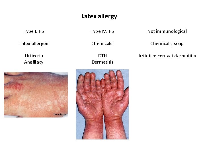 Latex allergy Type I. HS Type IV. HS Not immunological Latex-allergen Chemicals, soap Urticaria