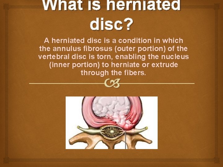 What is herniated disc? A herniated disc is a condition in which the annulus