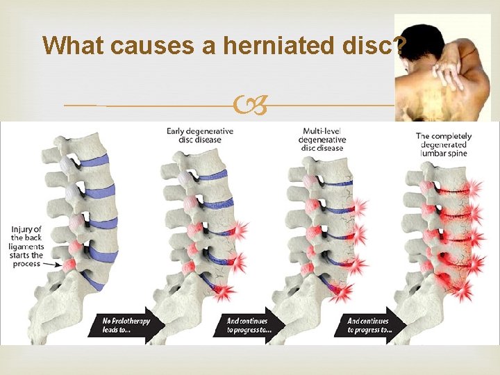 What causes a herniated disc? As we age, the spinal discs gradually Lose fluid