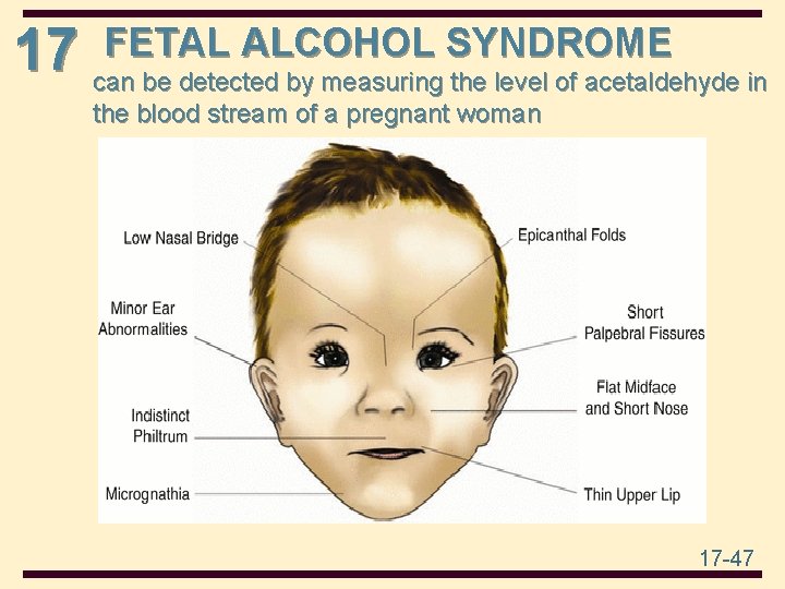 FETAL ALCOHOL SYNDROME 17 can be detected by measuring the level of acetaldehyde in