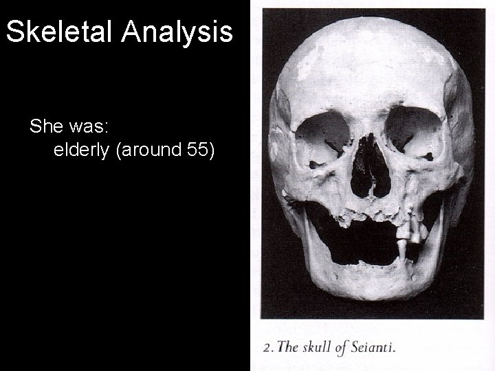 Skeletal Analysis She was: elderly (around 55) 