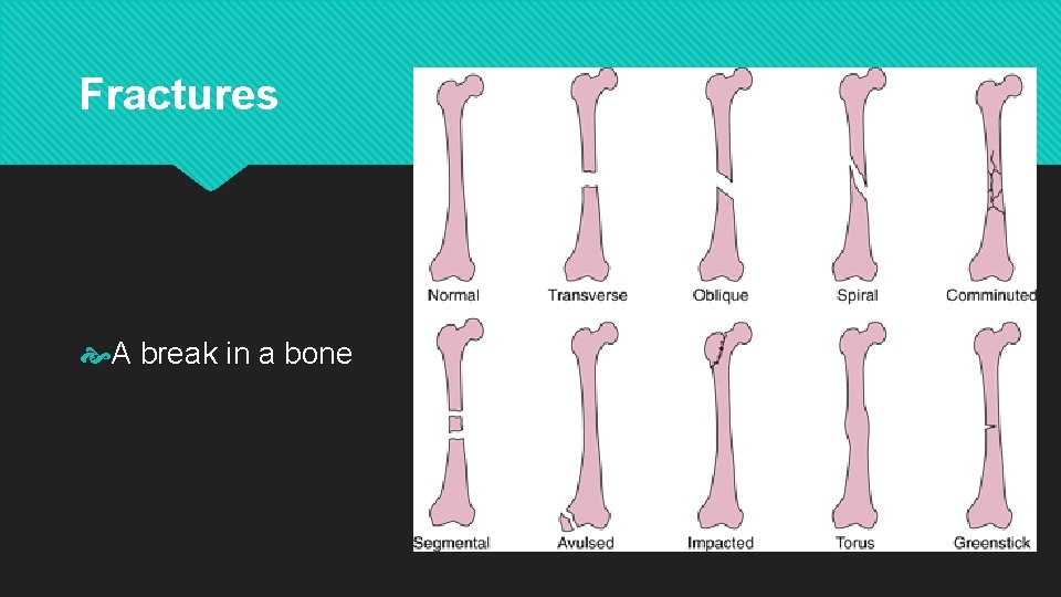 Fractures A break in a bone 