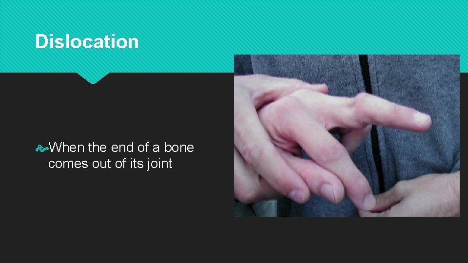 Dislocation When the end of a bone comes out of its joint 