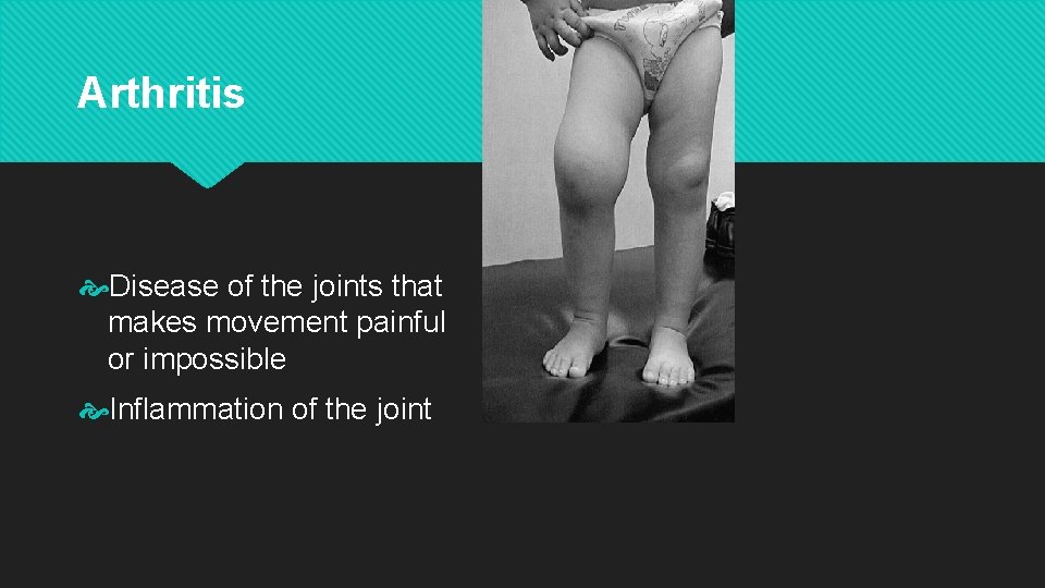 Arthritis Disease of the joints that makes movement painful or impossible Inflammation of the