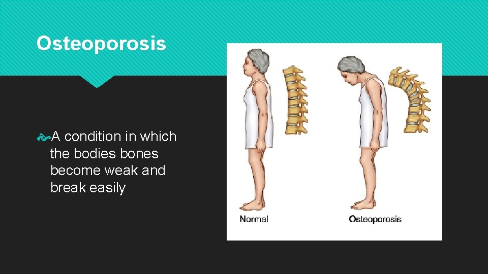 Osteoporosis A condition in which the bodies bones become weak and break easily 