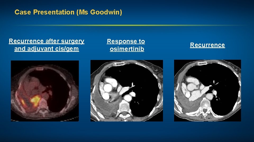 Case Presentation (Ms Goodwin) Recurrence after surgery and adjuvant cis/gem Response to osimertinib Recurrence