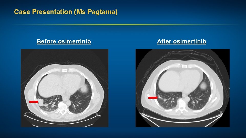 Case Presentation (Ms Pagtama) Before osimertinib After osimertinib 