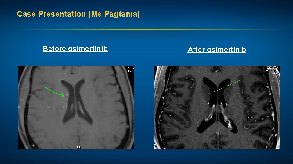 Case Presentation (Ms Pagtama) Before osimertinib After osimertinib 