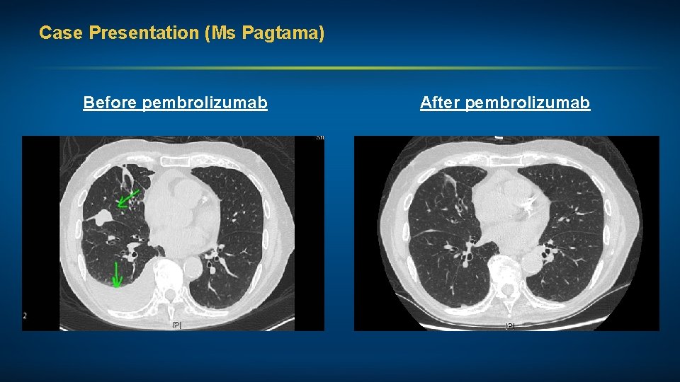Case Presentation (Ms Pagtama) Before pembrolizumab After pembrolizumab 