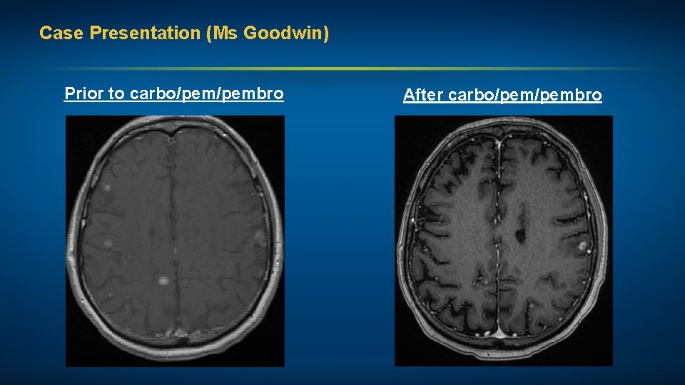 Case Presentation (Ms Goodwin) Prior to carbo/pembro After carbo/pembro 