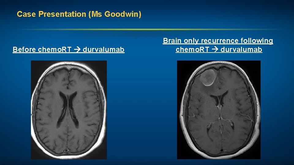 Case Presentation (Ms Goodwin) Before chemo. RT durvalumab Brain only recurrence following chemo. RT