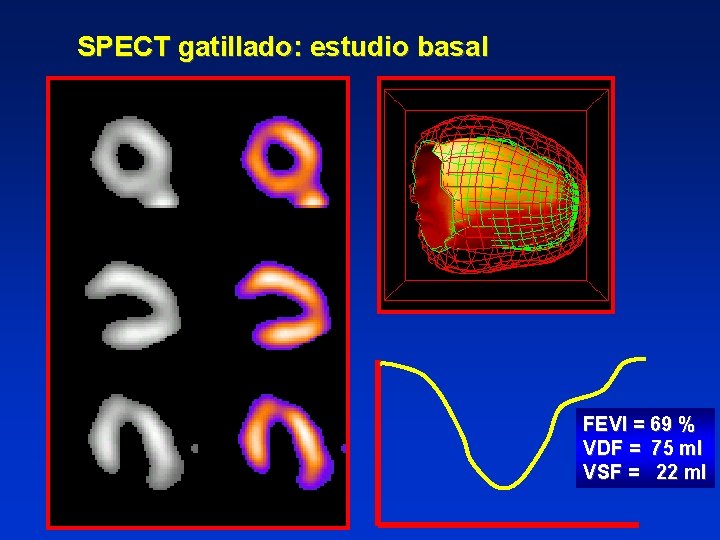 SPECT gatillado: estudio basal FEVI = 69 % VDF = 75 ml VSF =