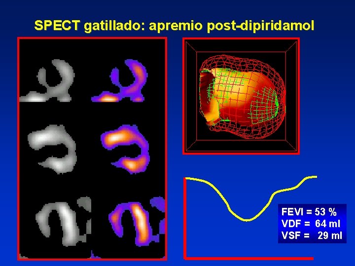 SPECT gatillado: apremio post-dipiridamol FEVI = 53 % VDF = 64 ml VSF =