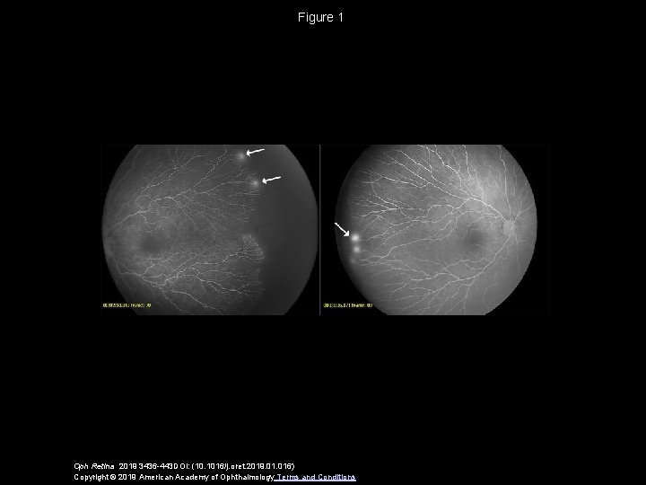 Figure 1 Oph Retina 2019 3436 -443 DOI: (10. 1016/j. oret. 2019. 016) Copyright