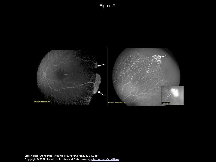 Figure 2 Oph Retina 2019 3436 -443 DOI: (10. 1016/j. oret. 2019. 016) Copyright